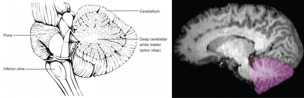 This figure shows the location of the cerebellum in the brain. In the top panel, a lateral view labels the location of the cerebellum and the deep cerebellar white matter. In the bottom panel, a photograph of a brain, with the cerebellum in pink is shown.