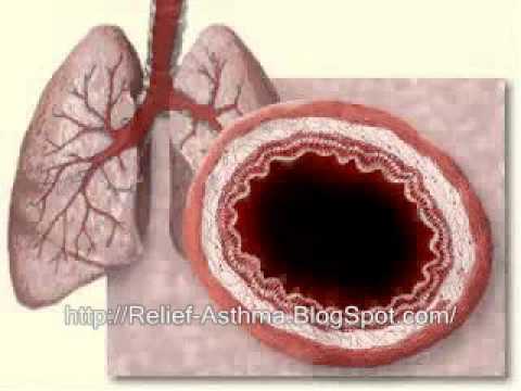 Thumbnail for the embedded element "How Asthma Causes a shortness in breath.A look inside your body"
