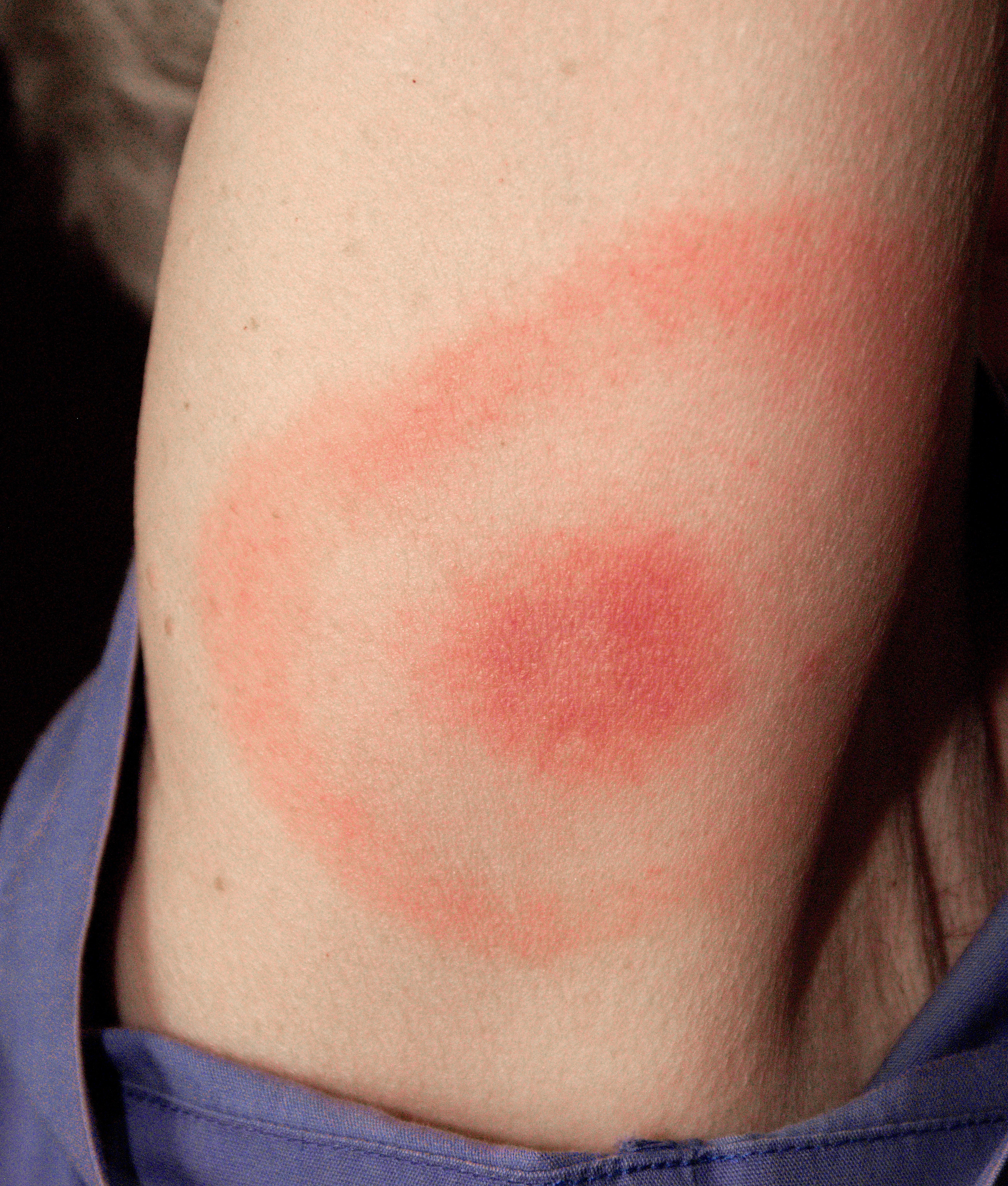 Erythema migrans-erythematous rash in Lyme disease