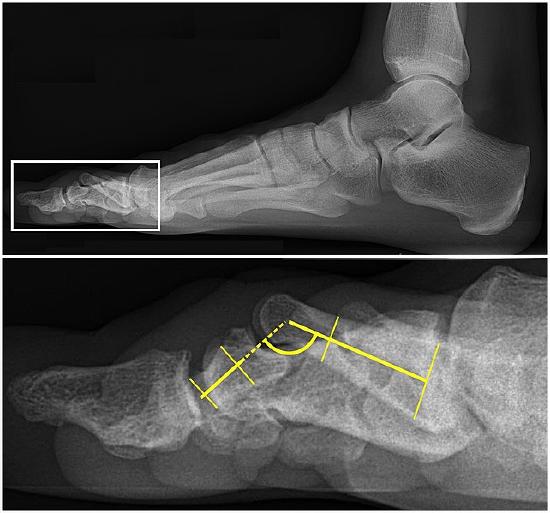 Hammer toe x-ray