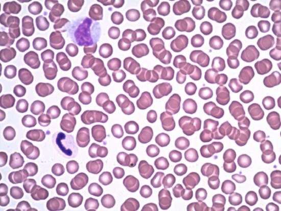 blood smear showing red blood cells and 2 different white blood cells