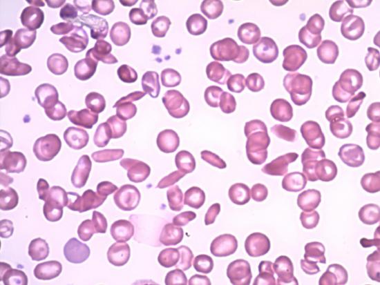 blood smear with sickled cells.