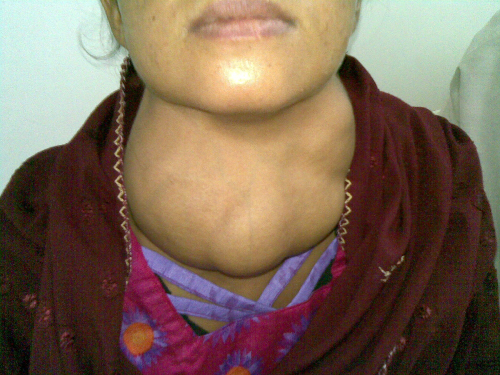 A goiter on a woman's neck. It is an expanded, lumpy structure.