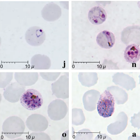 Microscope images of Plasmodium (small, purple dots) inside of red blood cells (translucent, reddish circles)