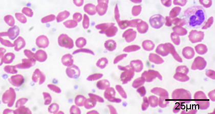 The micrograph shows a smear of red blood cells, some are disc-shaped and compressed in the center, whereas some are crescent-shaped. Each red blood cell is about five microns across.