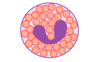Eosinophils are filled to capacity with small granules and have a regular shape and a horseshoe-shaped nucleus.