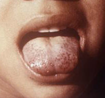 child sticking out a Scorbutic tongue