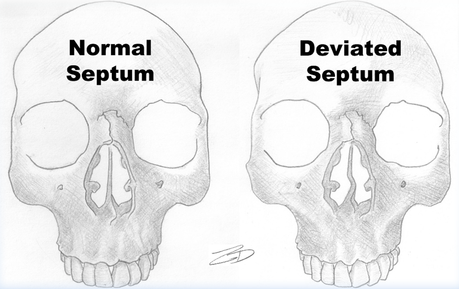 illustration of normal septum versus deviated septum