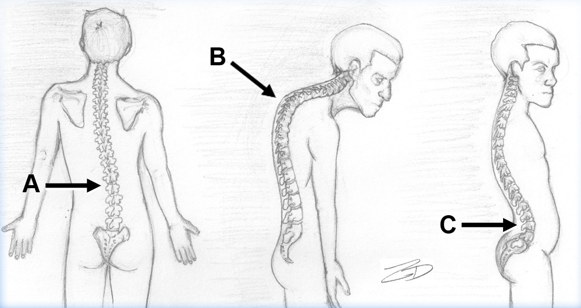 Illustration of abnormal spinal curvatures