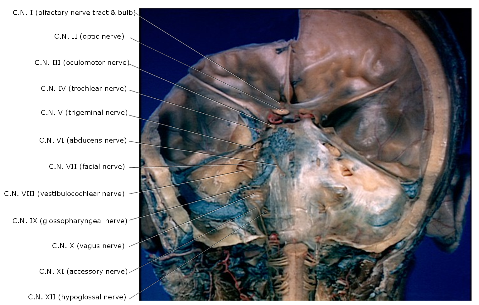 Cadaver image of cranial nerves