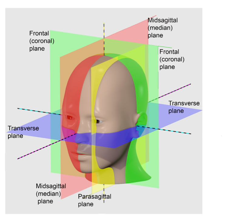 Imagen generada por computadora de la cabeza de una persona, mostrando el corte transversal como una hoja de papel que va desde la nariz hacia la parte posterior de la cabeza, el plano frontal (coronal) como papel