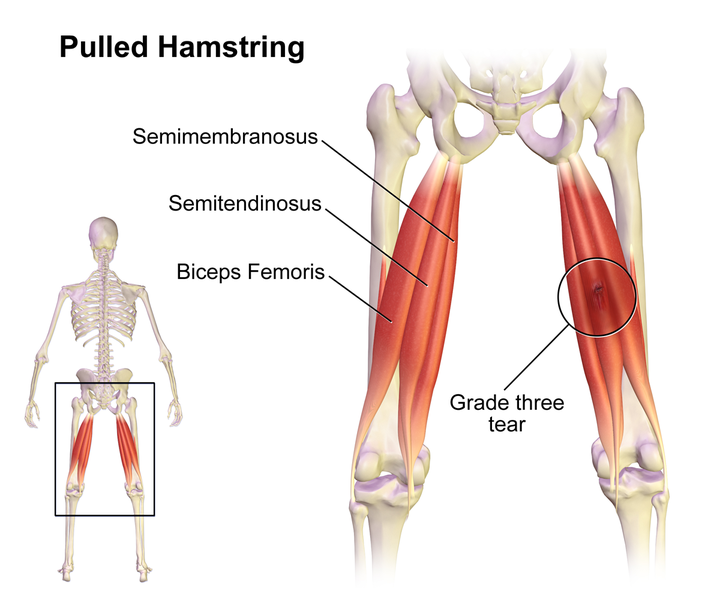 The hamstring muscles of the thighs. a tear is shown on the right leg.