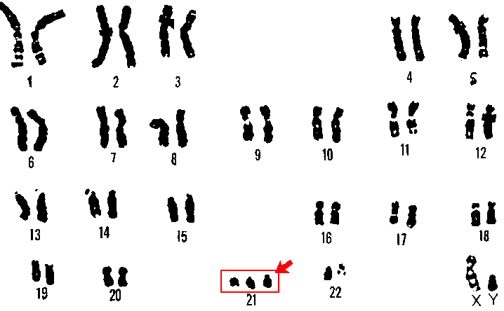 Karyotype of 21 trisomy (Down syndrome).