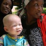 Photo shows a mother with an albino child.