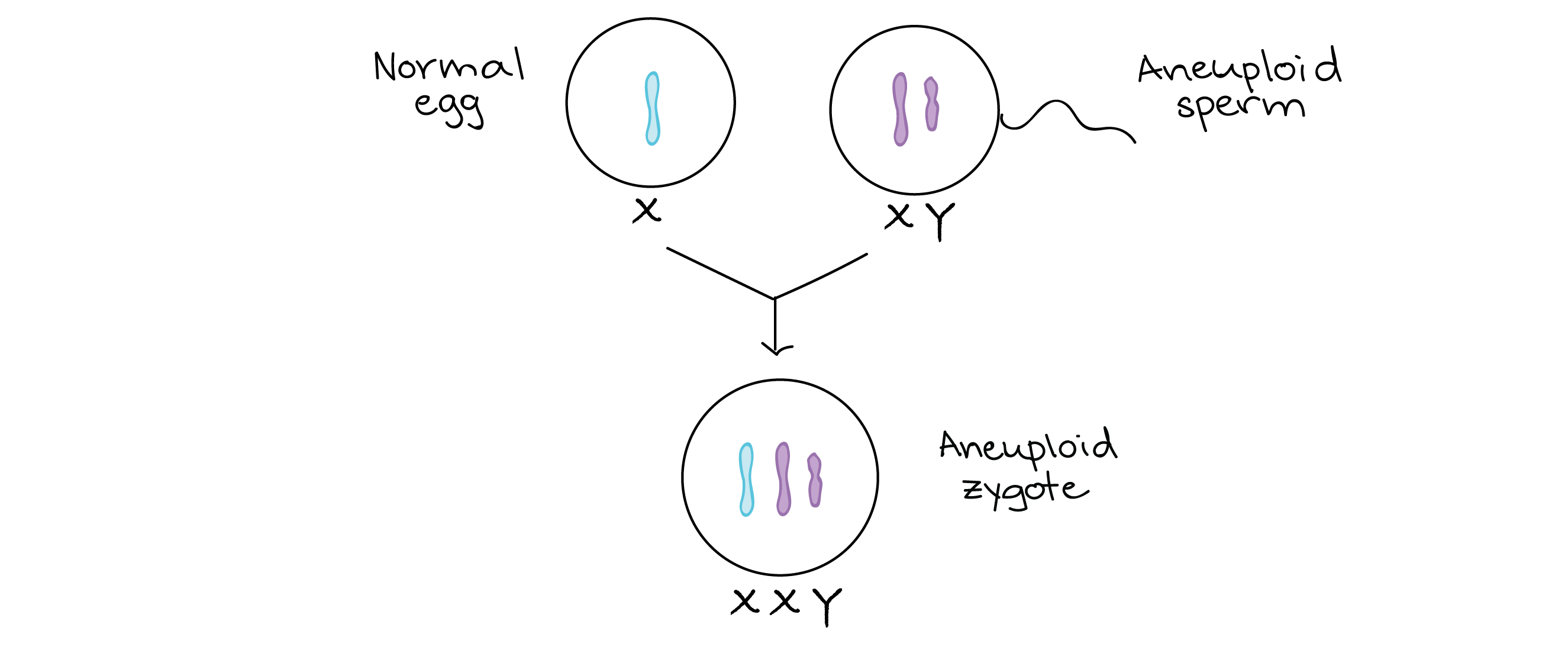 Fertilization of normal egg (X) with aneuploid sperm (XY)
