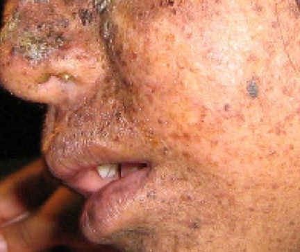 Photo shows a person with mottled skin lesions that result from xeroderma pigmentosa.