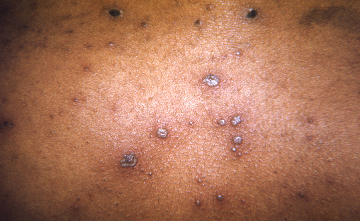 Foto de sarpullido de varicela en la parte posterior de los hombros de una persona.