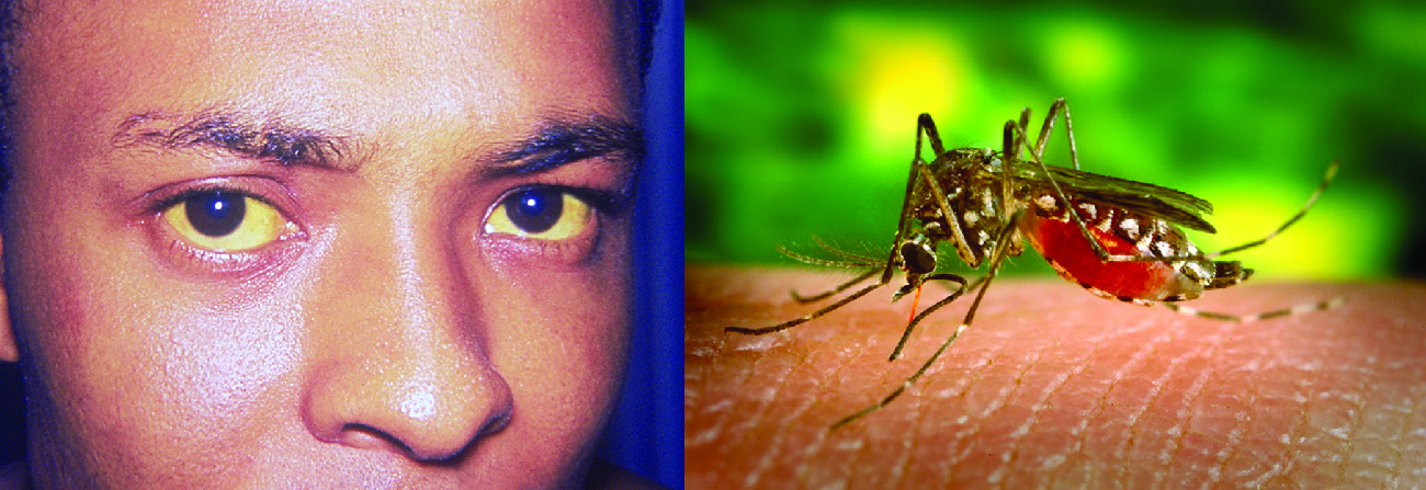 Foto de una persona con ojos amarillos. Foto de un mosquito en un brazo.