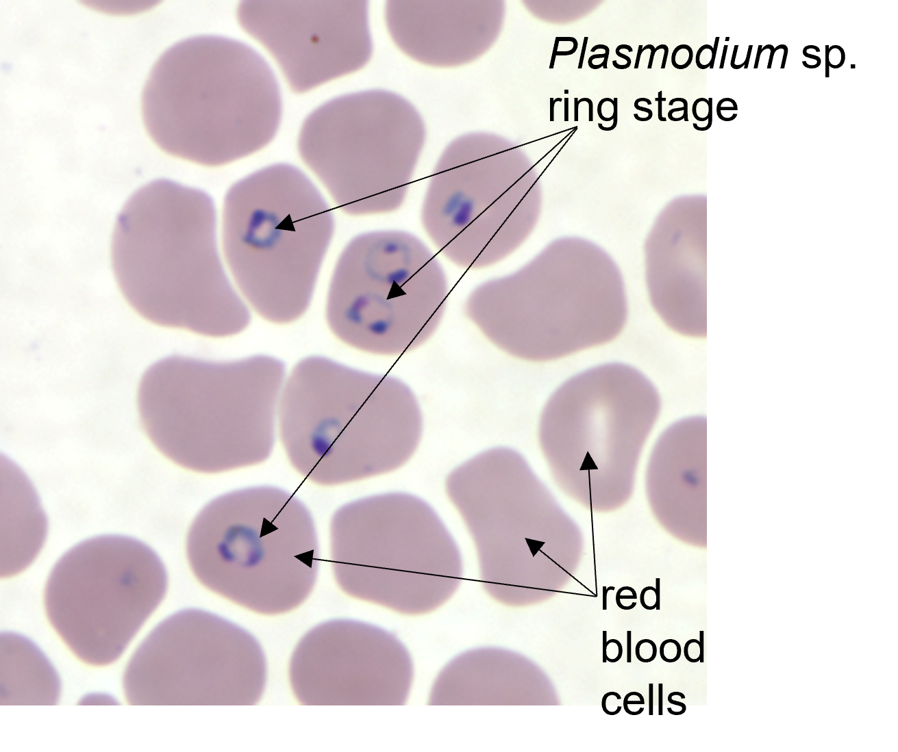 ring stage of Plasmodium inside of red blood cells in this microscopic image of infected human blood