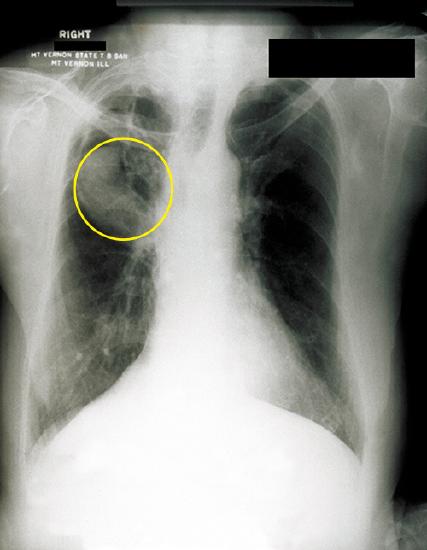 x-ray image of a person's lungs with Aspergillus fungal ball in lung