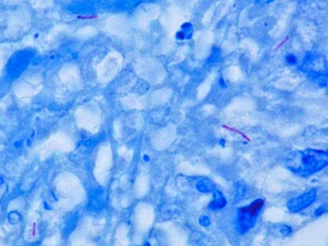 http://upload.wikimedia.org/Wikipedia/commons/9/9b/Mycobacterium_tuberculosis_Ziehl-Neelsen_stain_640.jpg