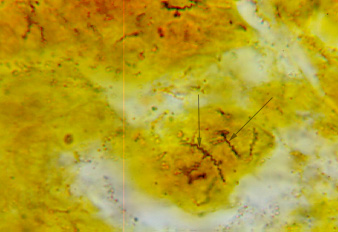 Photomicrograph of the spirochete <i>Treponema pallidum</i> in tissue.