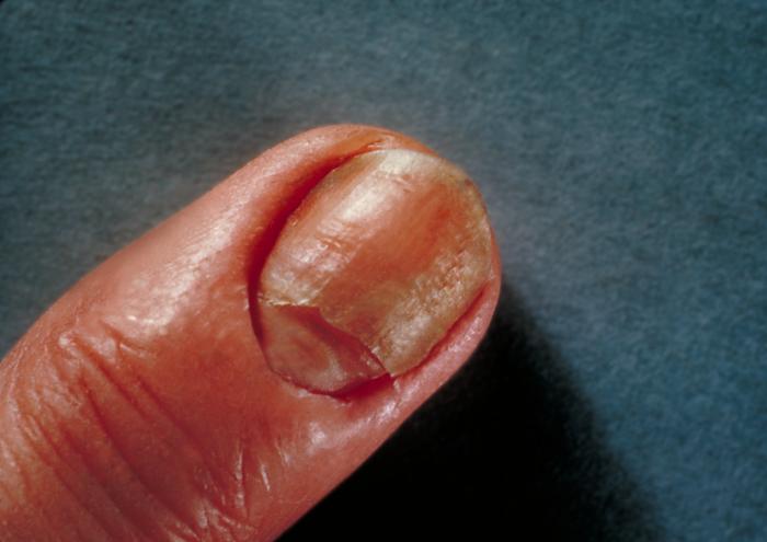 Photograph of a <em>Candida albicans</em> infection of the nails.