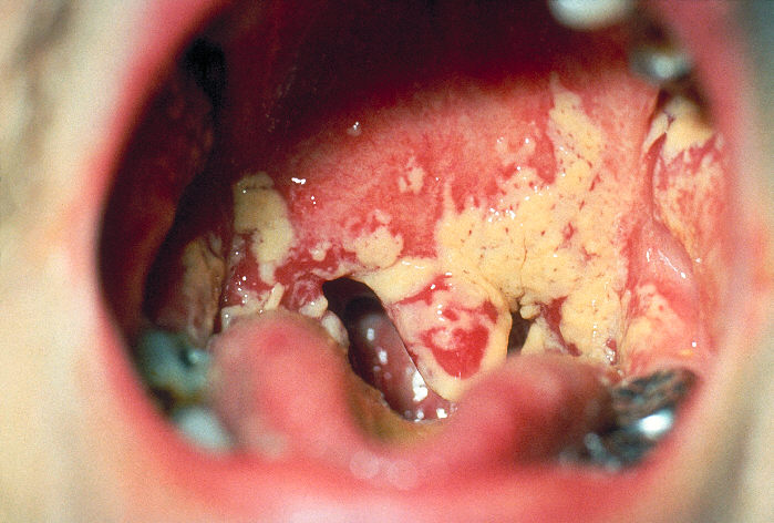Photograph of <em>Candida albicans</em> growing in the mouth causing thrush.
