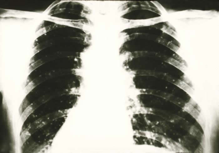 Photograph of a chest X-ray of a person with histoplasmosis showing granuloma.