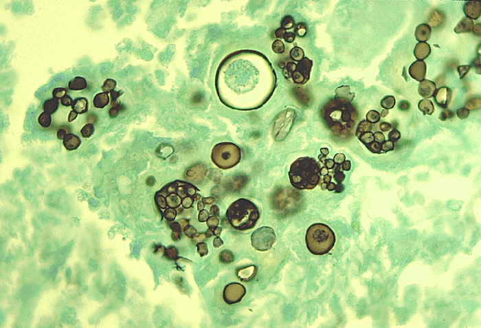 Photomicrograph showing <i>Coccidioides immitis</i> producing several endosporulating spherules in the lung of an infected person.