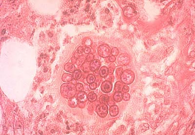 Photomicrograph showing <i>Coccidioides immitis</i> producing an endosporulating spherule in the lung of an infected person.