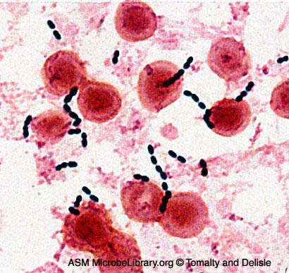 Photomicrograph of a Gram stain of <em>Enterococcus faecalis</em> in a blood culture showing Gram-positive cocci in chains.