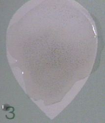 Photograph of a positive RPR test for syphilis showing clumping of carbon particles.