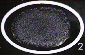 Photograph of a positive qualitative test for SLE showing clumping of the latex particles.