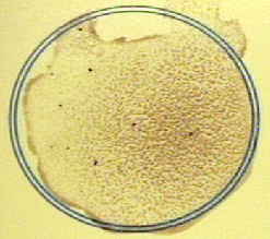 Photograph of a positive qualitative test for infectious mononucleosis showing clumping of the horse erythrocytes.
