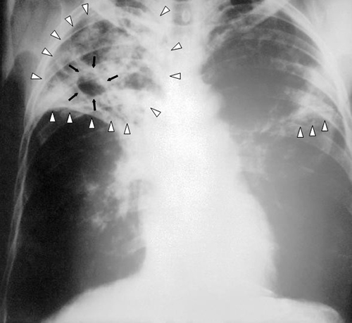 An X-ray showing ribs and other structures as white and the lungs as black. Light white webbings in the lungs are highlighted with white triangles. A dark region in this white webbing is outlined with black arrows.