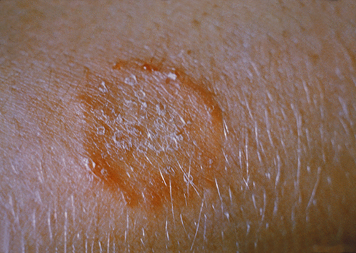 Close-up photo of a raised, red ring on skin.