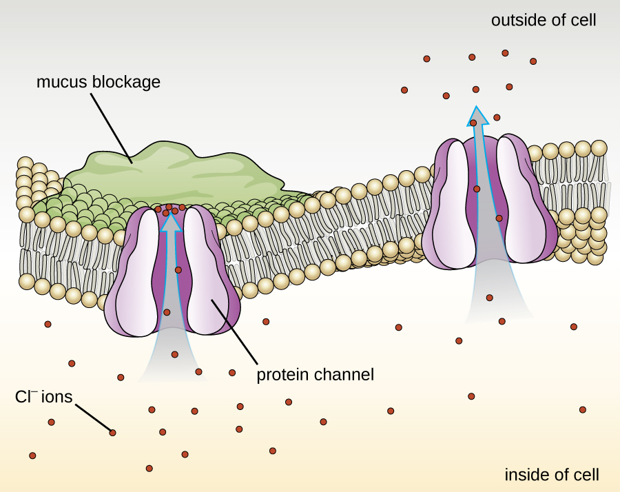 A drawing of a phospholipid bilayer in the center with two protein channels. One is open and lets Cl- flow out of the cell. The other is blocked by a mucus blockage on the outside of the cell; Cl- ions can’t flow through this channel.