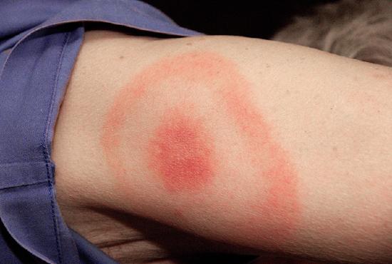 A photo of a bulls-eye rash; a red spot in the center and a red ring around that.