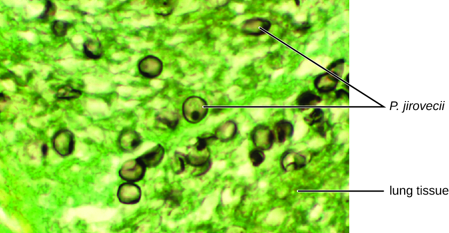 Micrograph showing green stained lug tissue and brown celled labeled P. jiroveci.