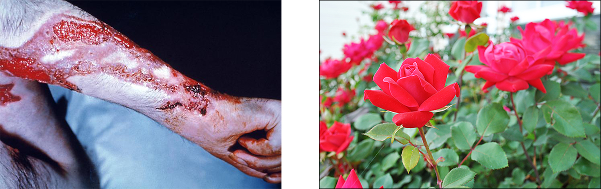 An arm with festering, bleeding scratches and a picture of a rose plant.