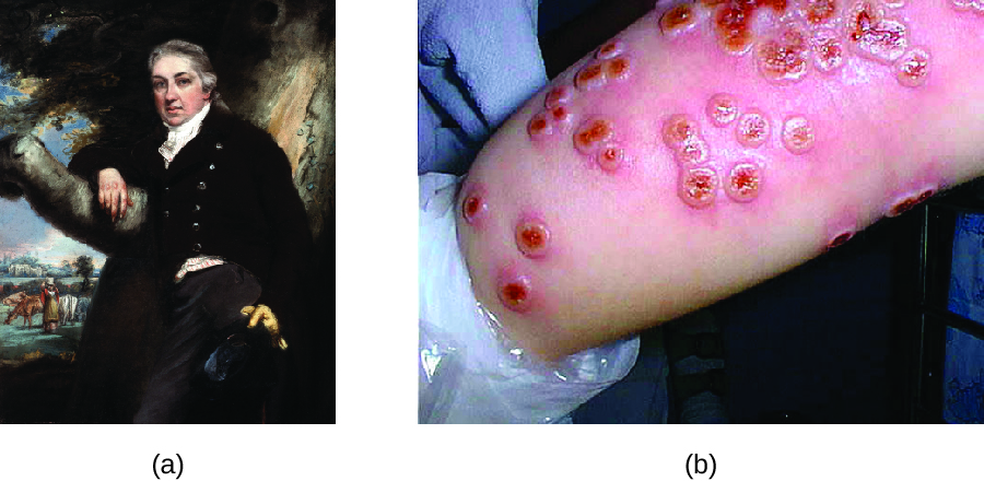 a) Painting of Edward Jenner. B) Photo of many red lumps on the skin.