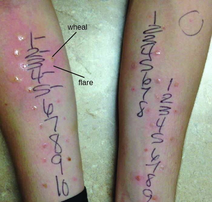 Photo of a person with many dots in a row on their skin. The dots are numbered and marks are next to those that are swollen.