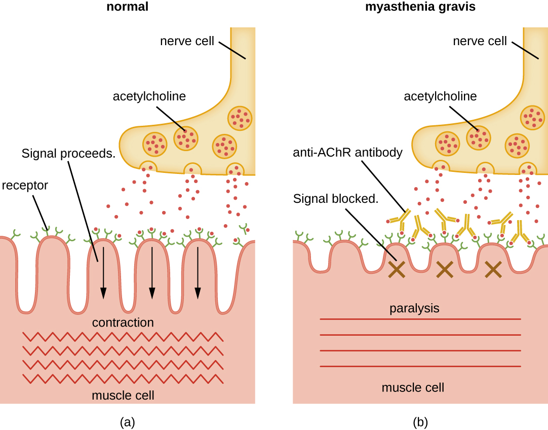 a) Diagram of a normal nerve cell releasing acetylcholine which binds to receptors on the muscle cell. This signal is processed and the muscle cell contracts. B) Diagram of myasthenia gravis. The nerve cell releases acetylcholine but anti-AChR antibodies bind to the acetylcholine so it cannot bind to the receptors on the muscle cells. Because the signal is blocked the muscle is paralyzed and does not contract.