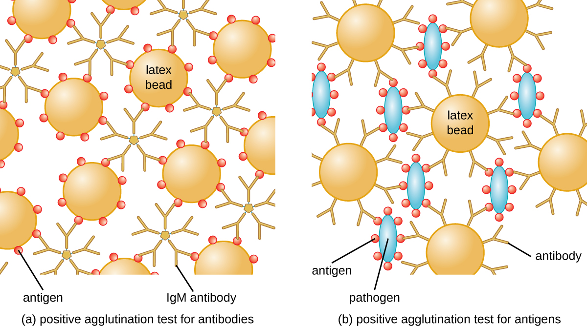 (a) A diagram of positive agglutination test for antibodies. Large circles (latex beads) have smaller circles (antigens) on their surface. IgM antibodies (6 Y shapes attached at their base) are bound to the antigens. B) A diagram of positive agglutination test for antigens. The latex beads have antigens on them. Smaller blue ovals (pathogens) have circles (antigens) on their surface. The antigens bind to the antibodies.