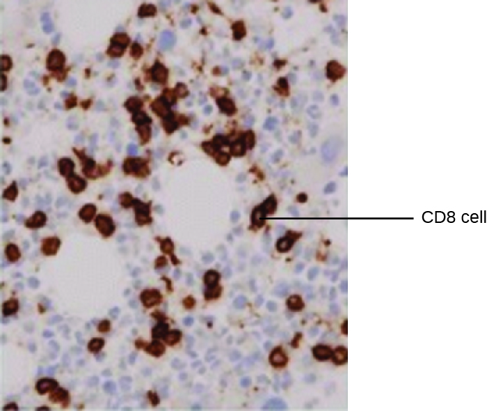 A micrograph of brown circular cells labeled CD8 cells.