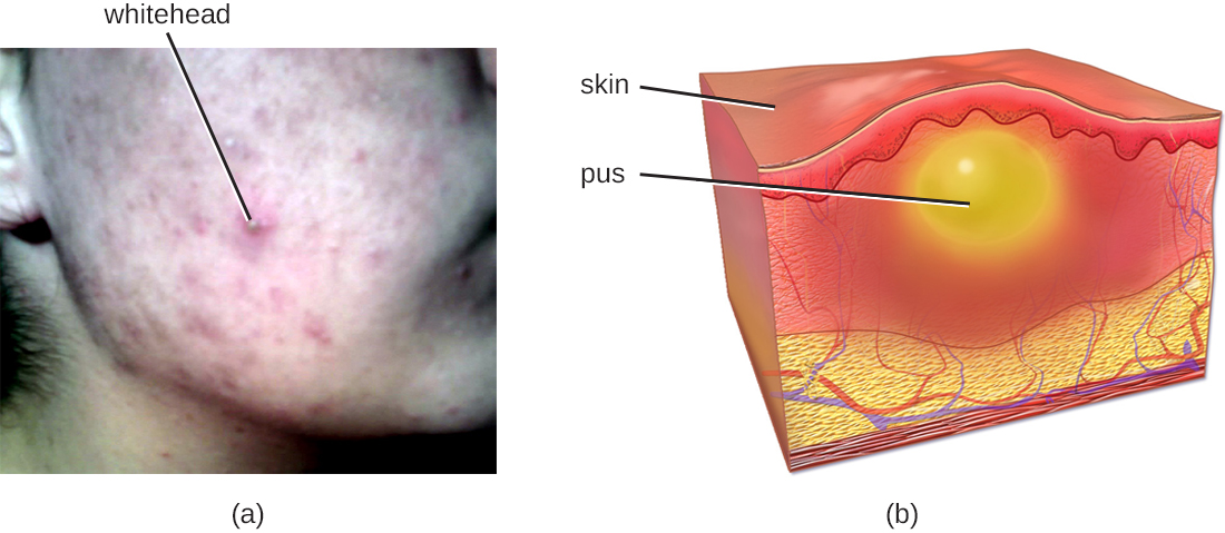 a) Acne (labeled whitehead) on a person’s cheek. B) A drawing of skin with a yellow bubble labeled pus. This is below a raised region on the skin.