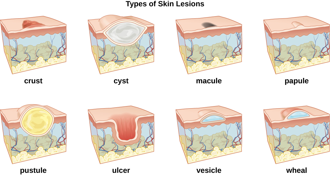 A table labeled types of skin lesions. Crust is shown as a raised region on the surface of the skin. Cyst is shown as a large white sphere in the upper layers of the skin. Macule is shown as a dark mark on the surface. Papule is shown as a raised bubble on the surface. Pusture is shown as a large yellow sphere in the upper layers of the skin. Ulcer is a large cavity in the skin. Vesicle is a small blue bubble in the upper regions of the skin. Wheal is a small blue bubble on the surface of the skin.