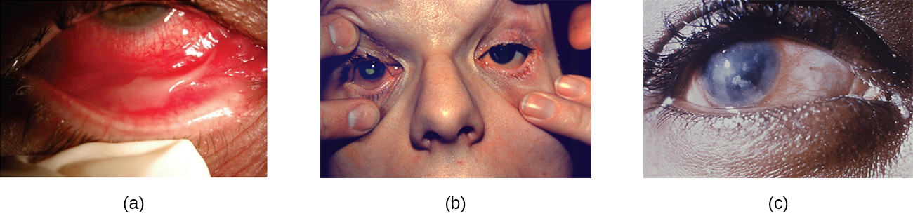 a) foto de un párpado tirado hacia atrás para mostrar una son rojas. B) Una foto de párpados inflamados. C) Una foto de un ojo con córnea turbia.