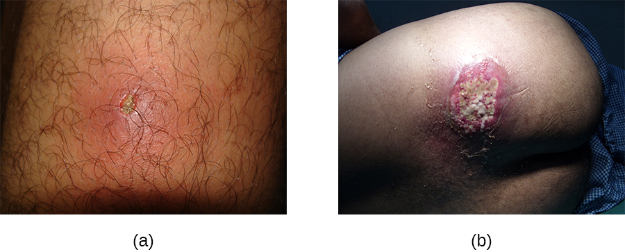 a) a photo of a small inflamed region with a white center. b) A large lesion with white and red.